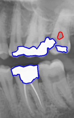 AugmenTory Dental Original Annotations